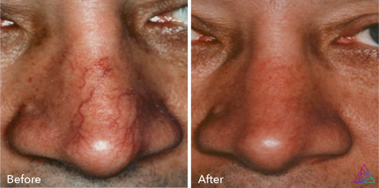 Vascular Lesion BA NOSE2 768x381