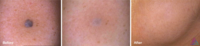 Vascular Lesion BA SPOT 768x177
